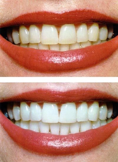 before and after look at teeth whitening results from Smile Source North