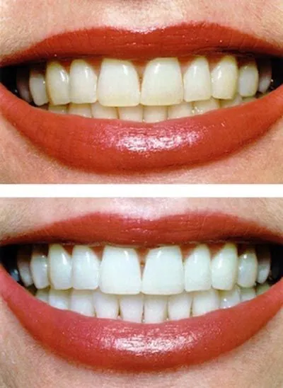 before and after look at teeth whitening results from Smile Source North
