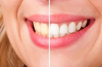closeup of the results of what our professional teeth whitening services can do