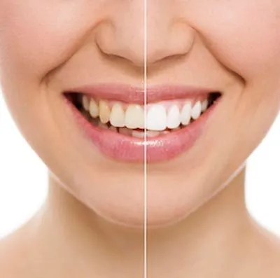 side-by-side view of our professional teeth whitening services at Smile Source South Hill