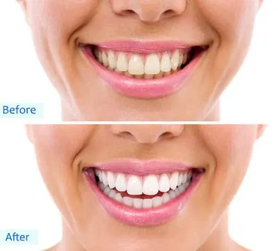 comparison showing the before and afters of teeth whitening treatment at Smile Source Spokane Valley
