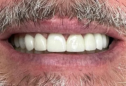 After image